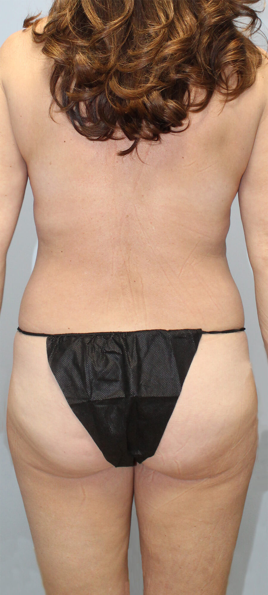 Case--5470 | Before Liposuction 3