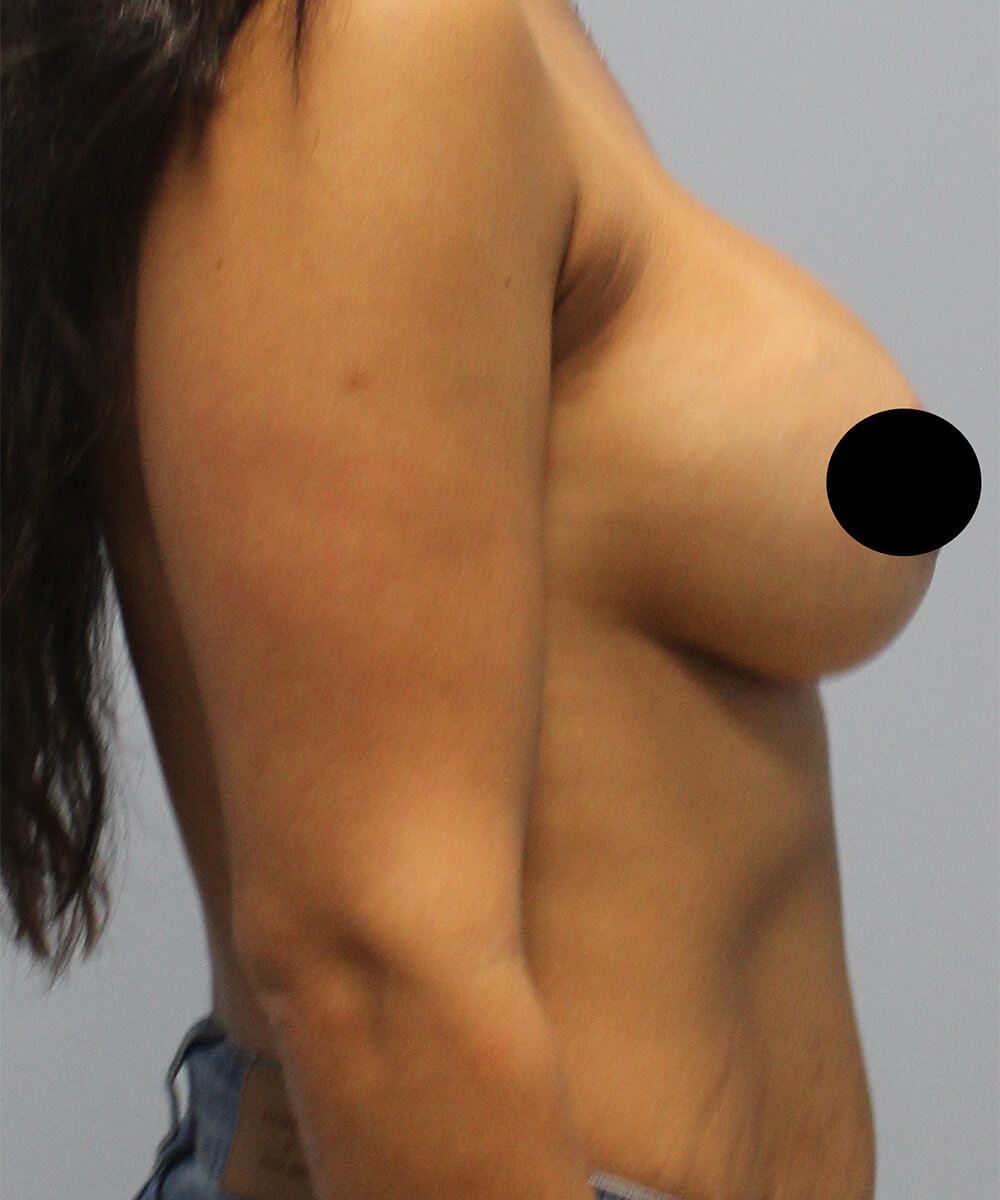 Case--3995 | After Breast Augmentation 2