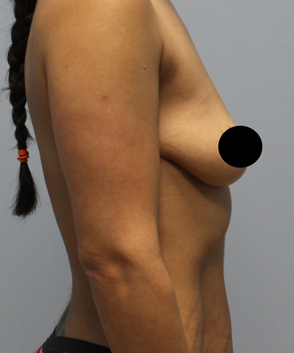 Case--3995 | Before Breast Augmentation 2