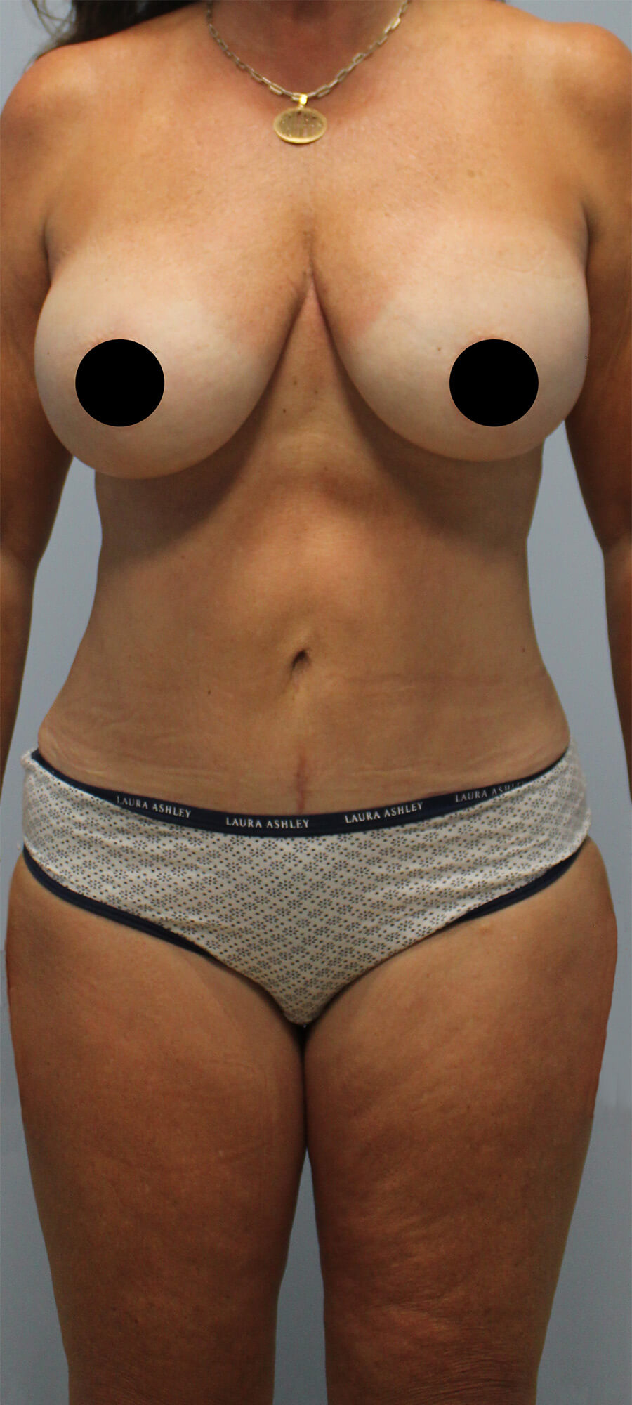Case--5470 | After Tummy Tuck