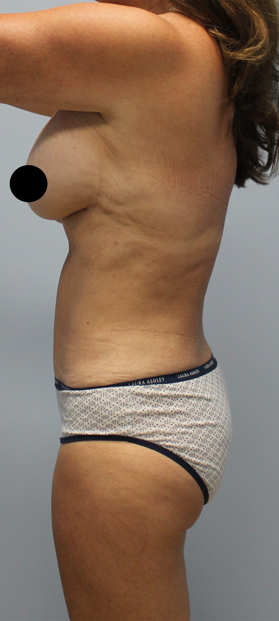 Case--5470 | After Liposuction 2