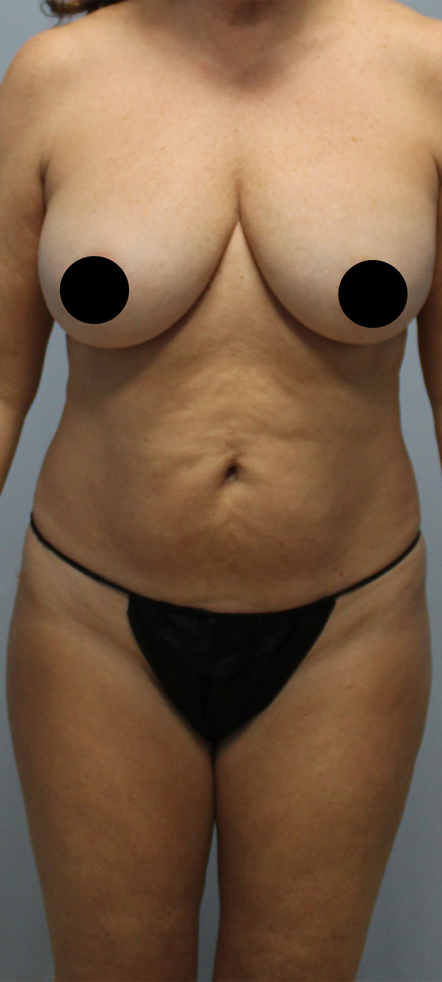 Case--5470 | Before Tummy Tuck