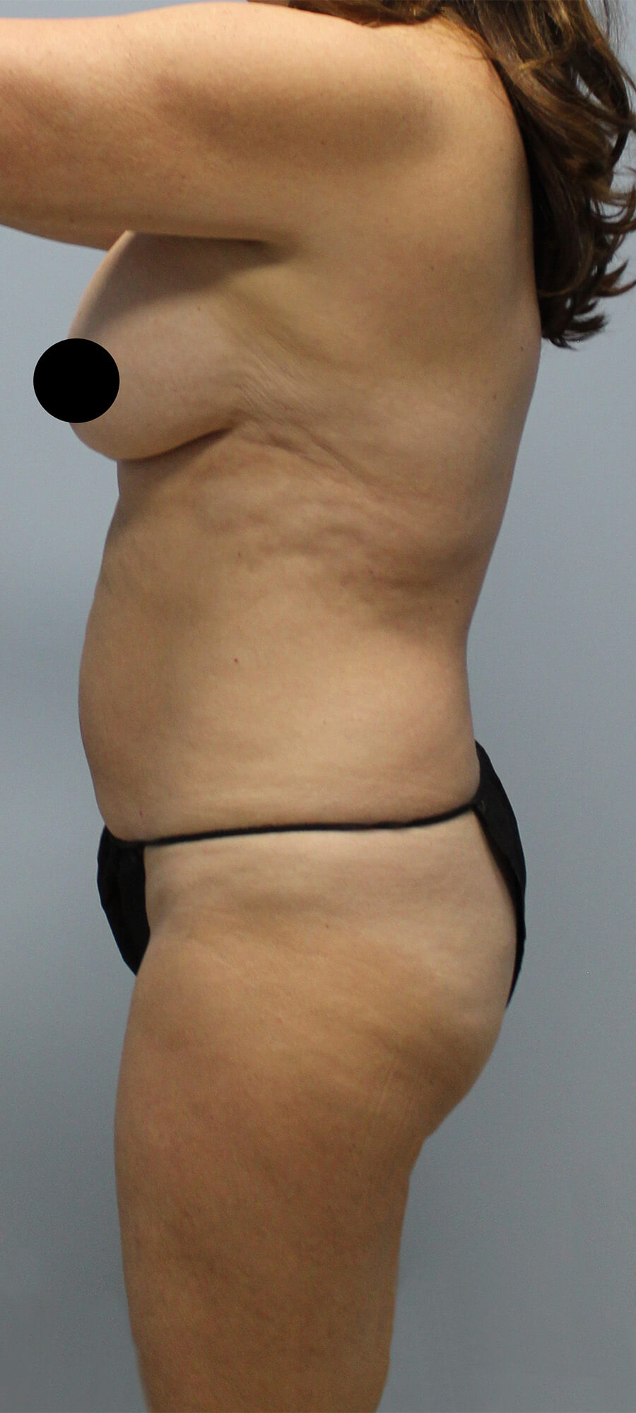 Case--5470 | Before Liposuction 2