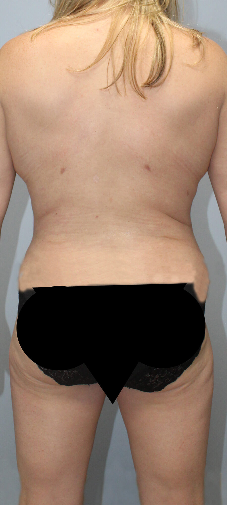 Case--9626 | After Tummy Tuck 3