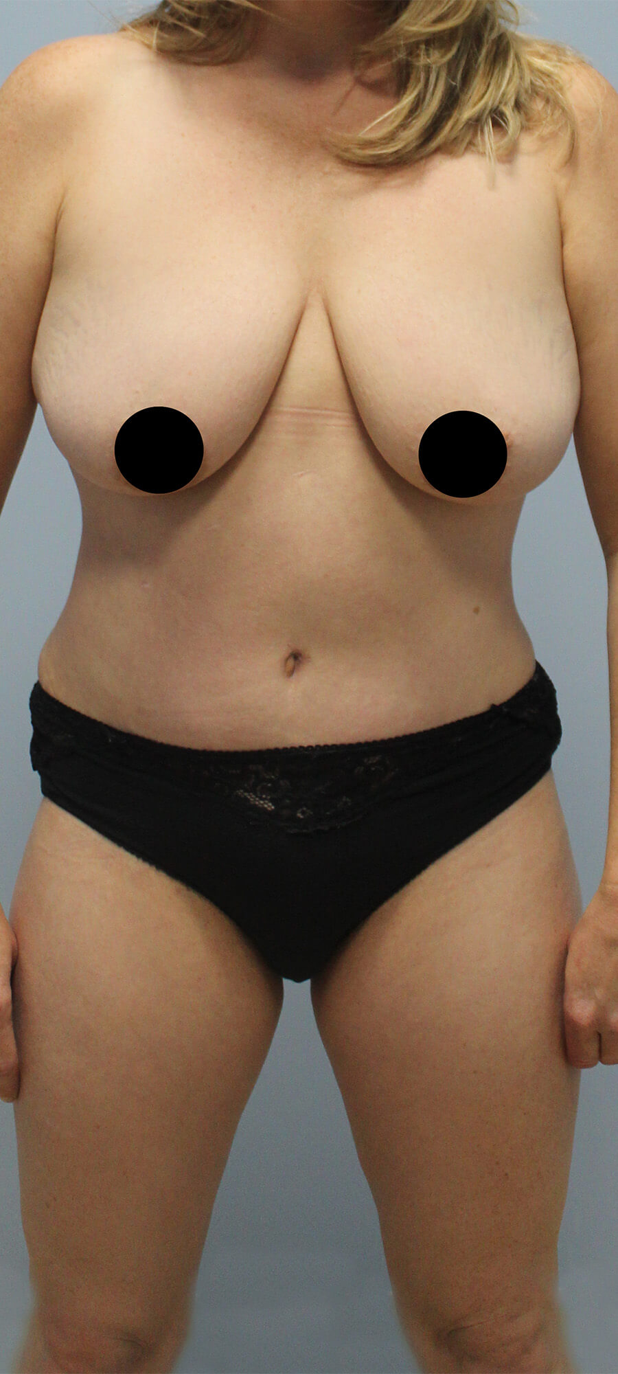 Case--9626 | After Tummy Tuck