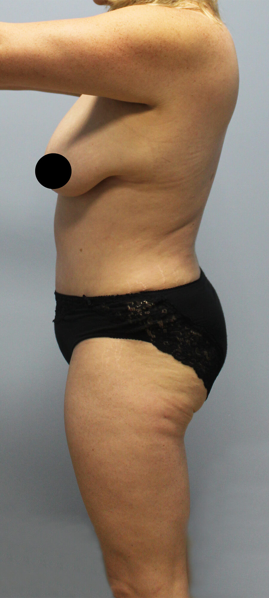 Case--9626 | After Tummy Tuck 2