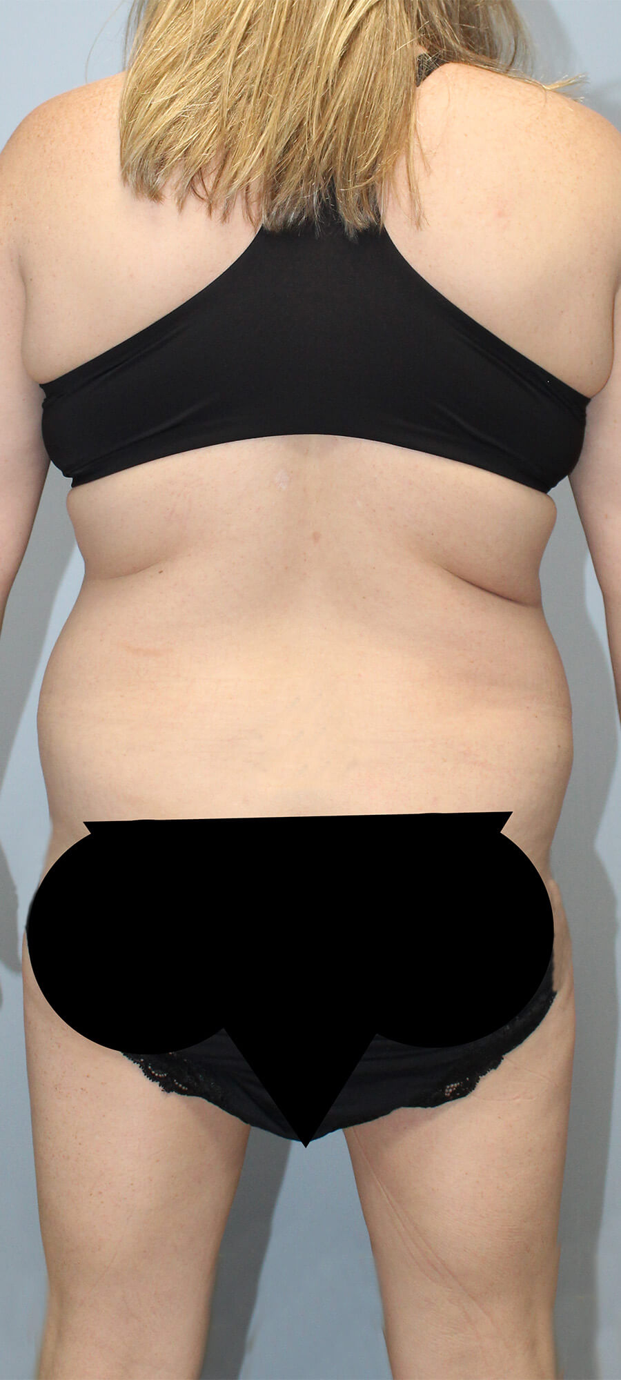 Case--9626 | Before Tummy Tuck 3