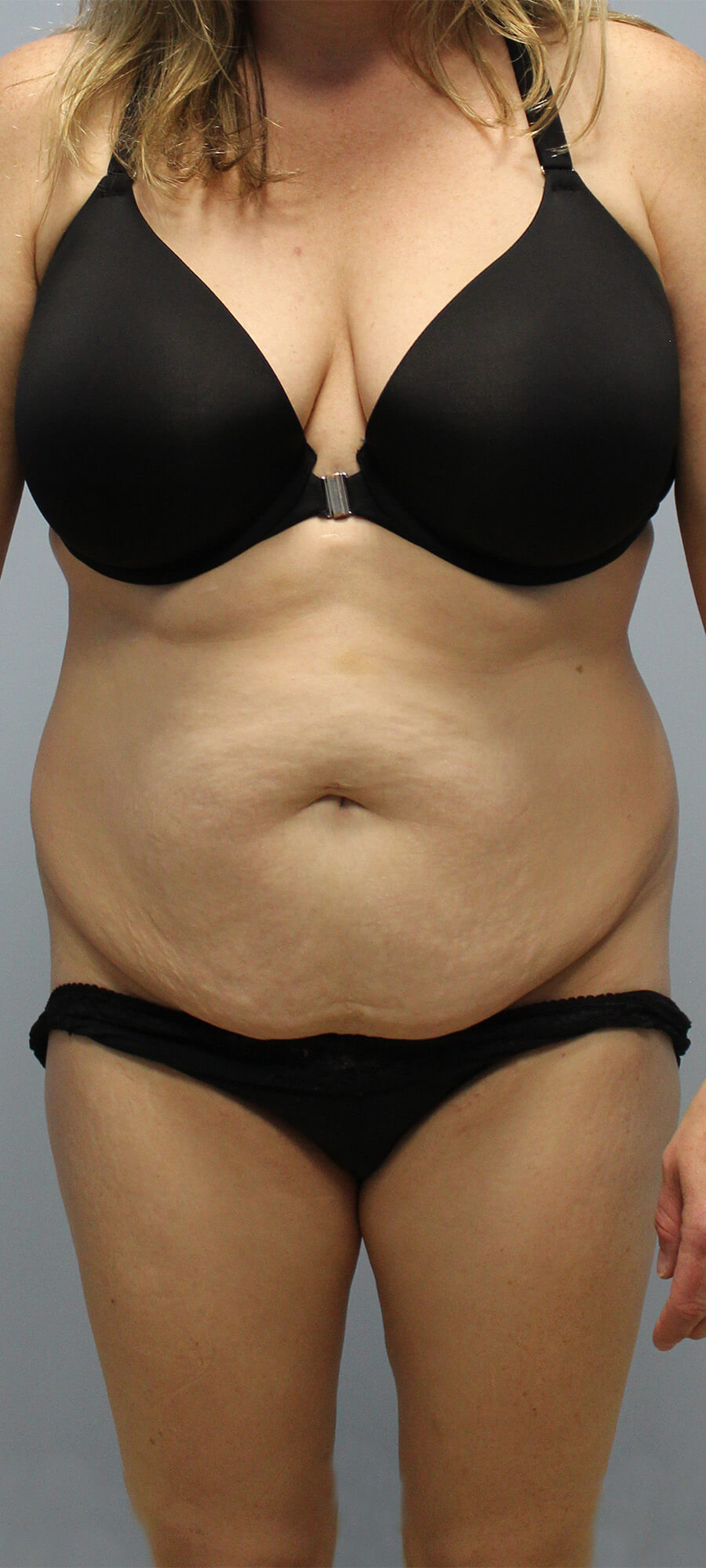 Case--9626 | Before Tummy Tuck