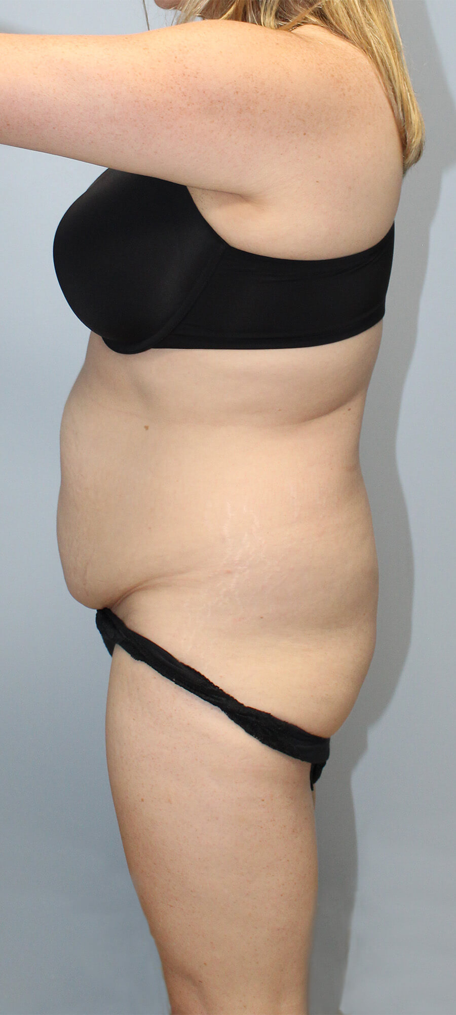Case--9626 | Before Tummy Tuck 2