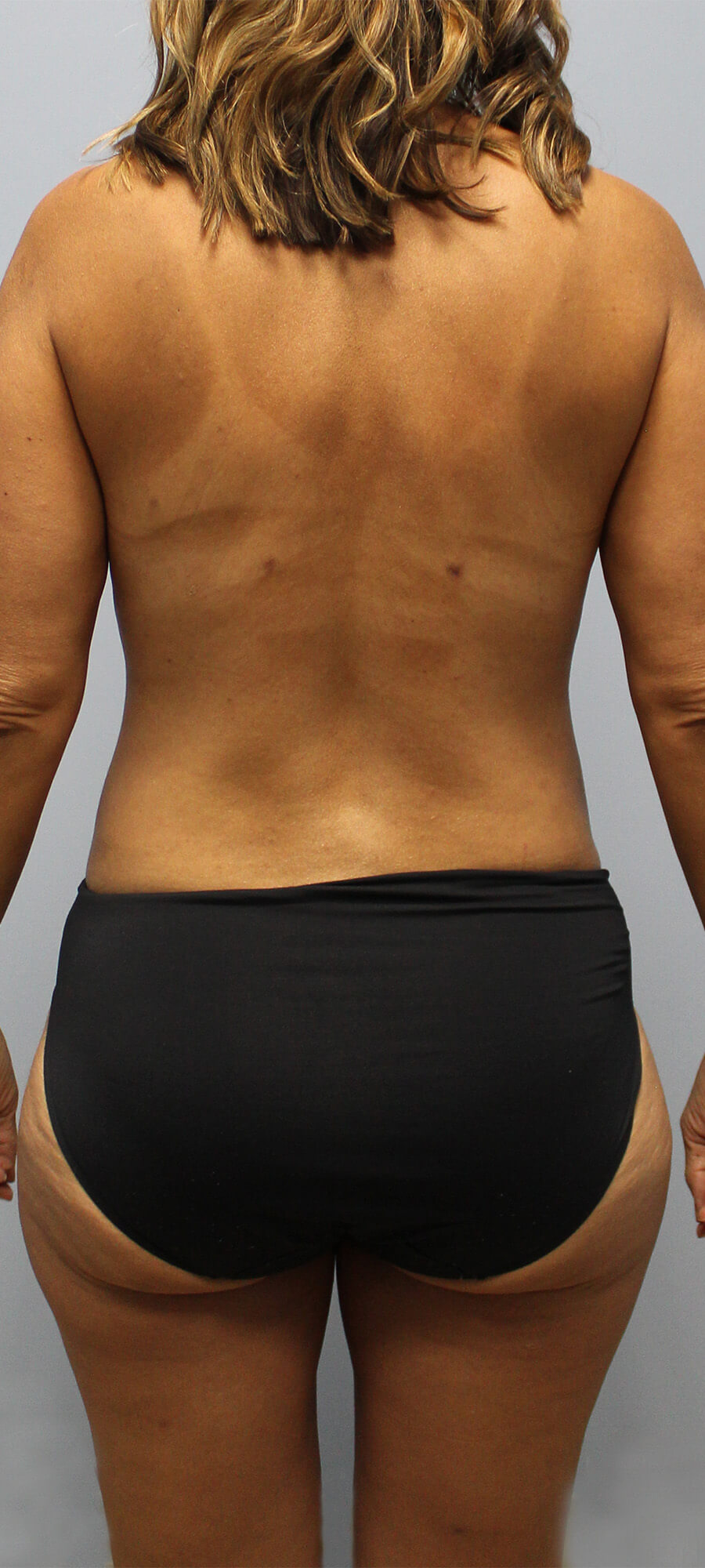 Case--4843 | After Tummy Tuck 2