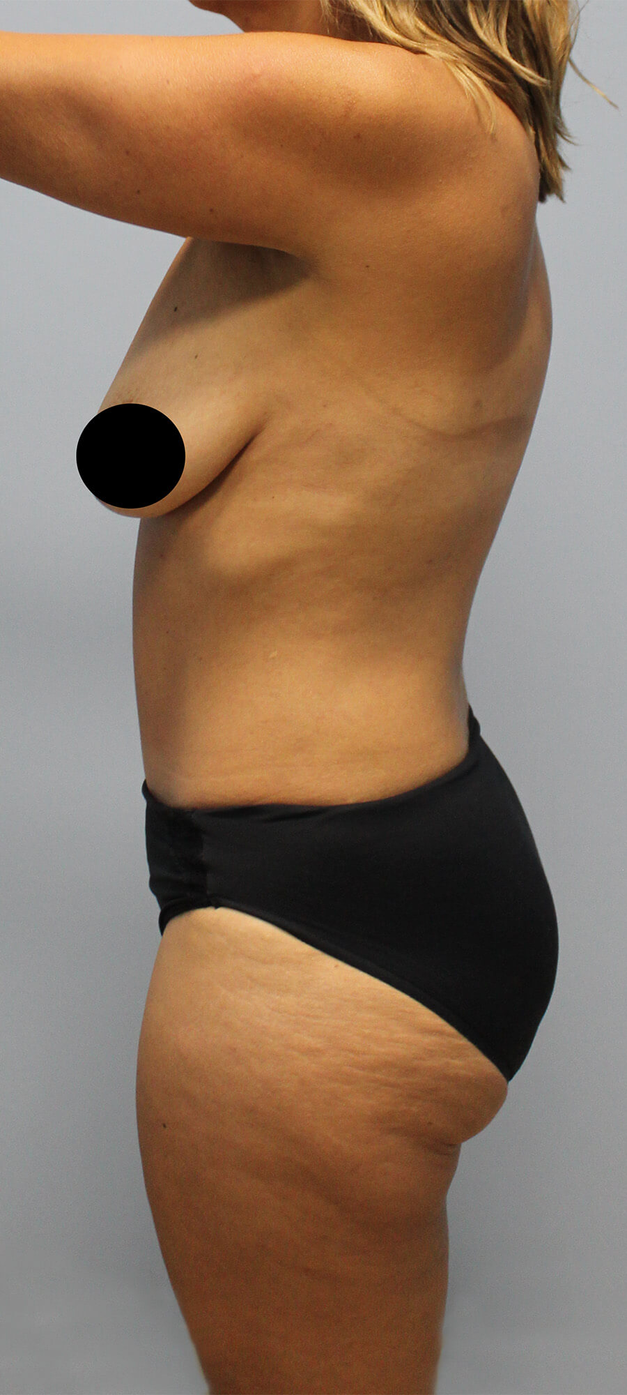 Case--4843 | After Tummy Tuck 3