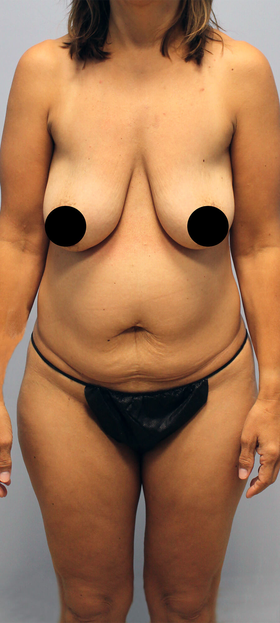 Case--4843 | Before Tummy Tuck