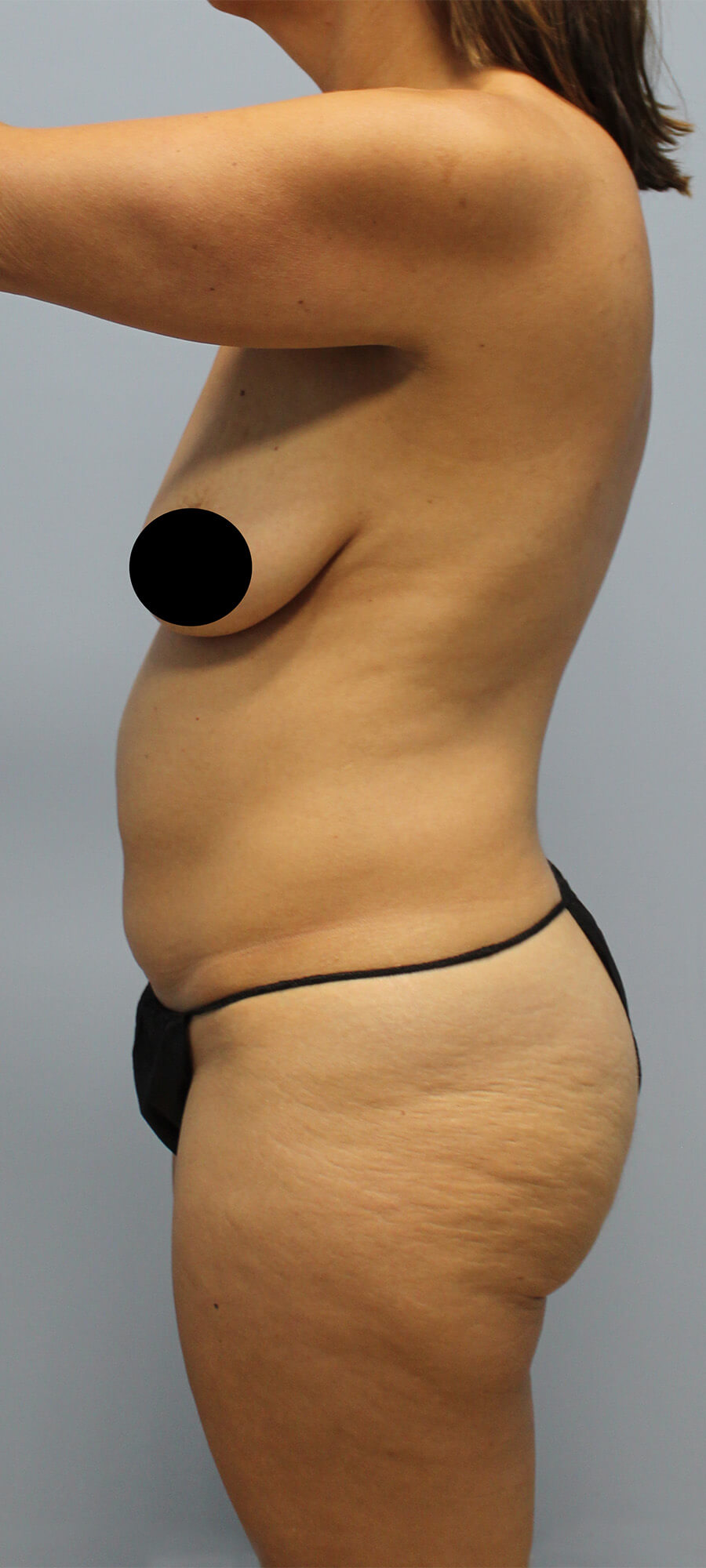 Case--4843 | Before Tummy Tuck 3